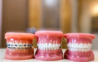 different types of dental braces